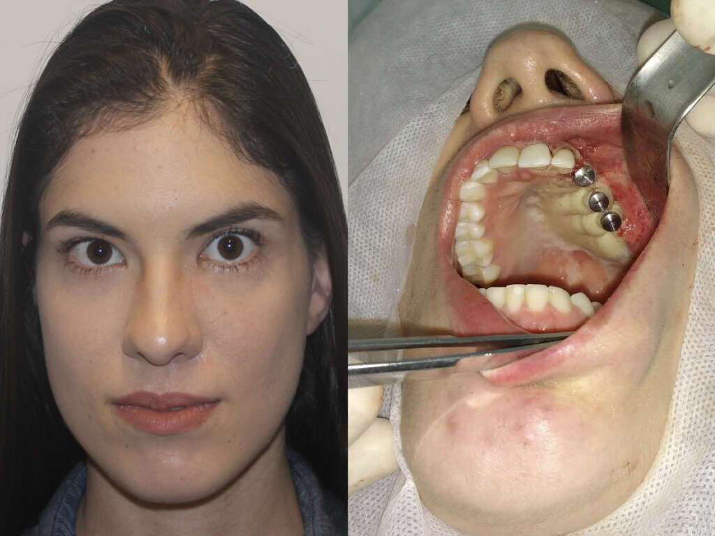 Post operative view with osteointegrated dental implants